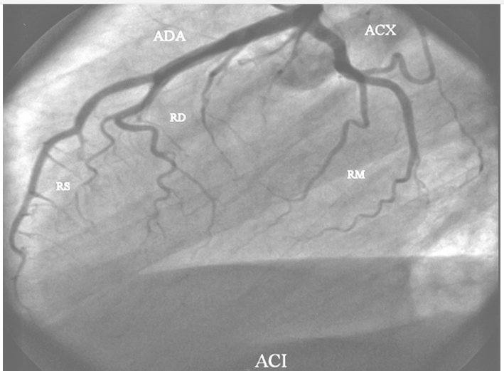 Arteria coronaria izquierda. Anatomía normal. ADA: Arteria descendente anterior; RD: diagonal de Rama; RS: Ramas septales; ACX: Arteria circunfleja; RM: Ramas marginales o laterales.