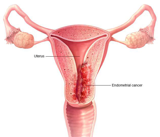 Esta imagen muestra el útero y el endometrio, la capa interna del útero donde se origina el cáncer de endometrio. El cáncer se muestra como un crecimiento anormal en el endometrio.